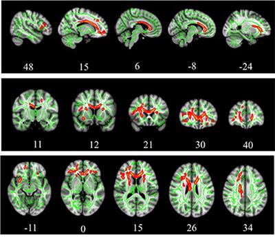 Frontiers | Disruption of white matter integrity and its relationship